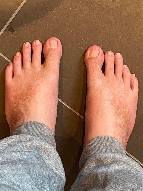 Why Are There Yellow Spots On My Feet at Malik Keck blog