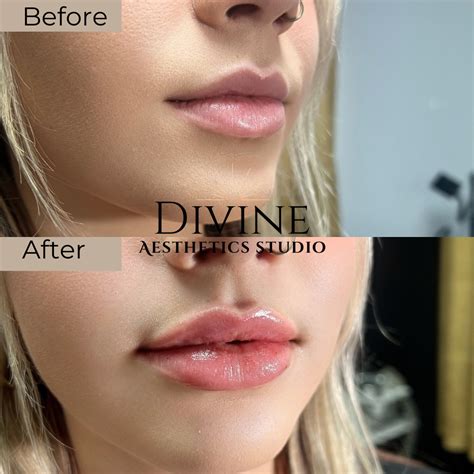 Volume Restoration | Dermal Fillers, Radiesse®, PRF & Fat Dissolver in New Braunfels TX — Divine ...