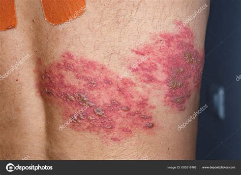 Herpes Leg Rash