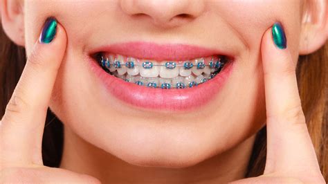 Braces And Gum Swelling at Olivia Quinn blog