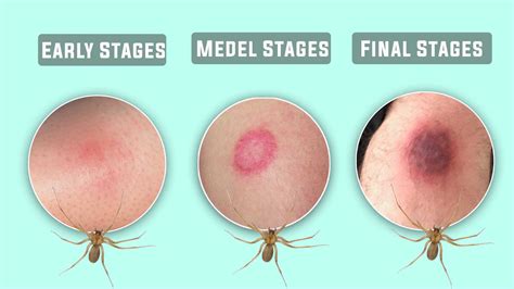 Brown Recluse Spider Bite Pictures Early Stages