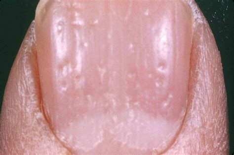 Pictures of Psoriatic Arthritis: What It Looks Like