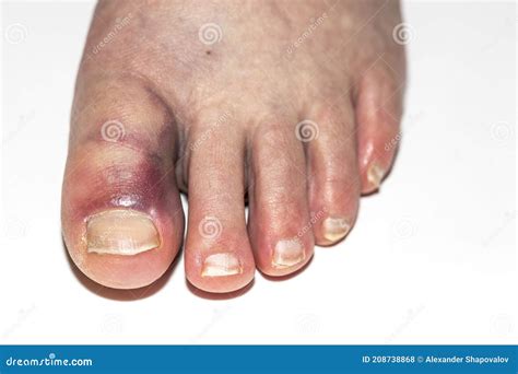 Close Up View of Damaged Foot with Bruise Big Toe. Injuries Concept ...