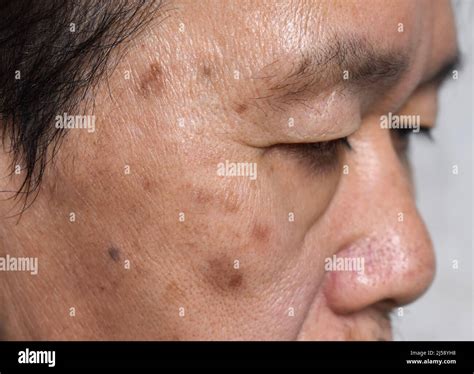 Small brown patches called age spots on face of Asian elder man. They are also called liver ...
