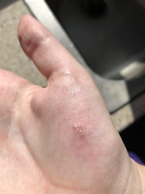 The forbidden pops of dyshidrotic eczema. Tiny blisters that are highly not recommended for ...