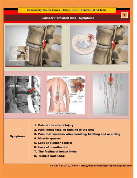 Medical Notes For Students: Lumber Herniated Disc - Symptoms