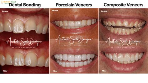 What Is Teeth Bonding? Benefits, Process & Costs Explained | Dr. Cuong - Ho Chi Minh City Dental ...