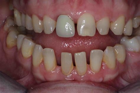 Veneers For Overlapping Front Teeth at Glen Williams blog