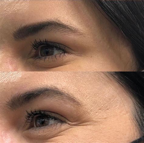 Crows Feet Eyes | Crows Feet Treatment in California & Arizona – NAKEDMD Medspa