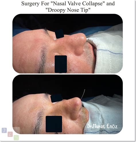 Nasal Valve Collapse and Treatment