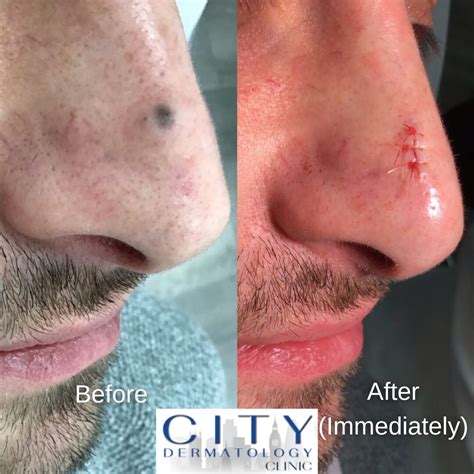 Before and After Photos Mole Removals