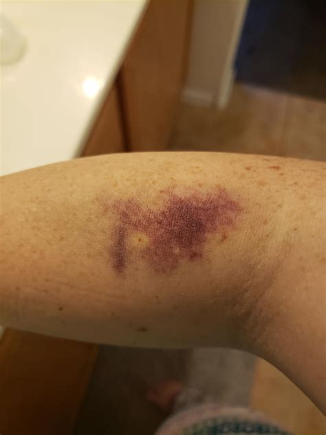 Iv Hematoma