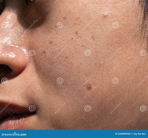 Dark Spots Called Age Spots and on the Face of Asian Man. they are Also Called Liver Spots ...