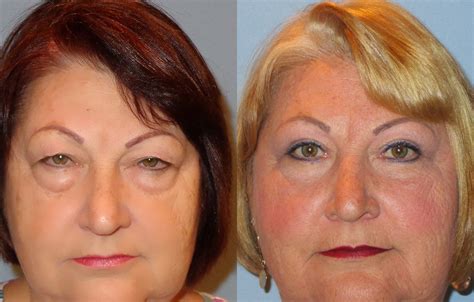 Lower Eyelid Surgery