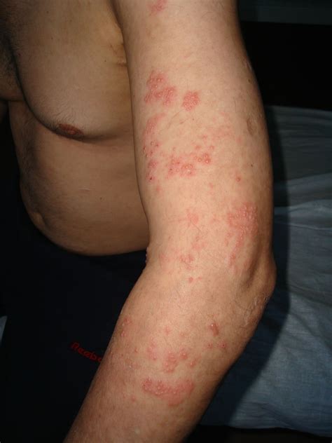Herpes On Arms