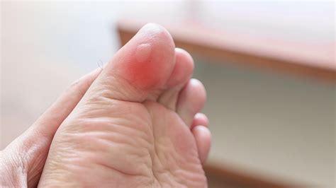 4 Tips for Treating Blisters on Your Feet - GoodRx