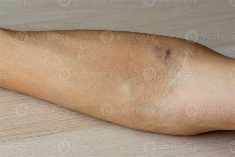 Bruises on the arm from the blood draw needle. 25901082 Stock Photo at Vecteezy