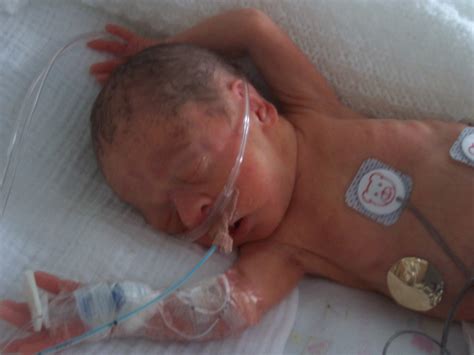SAMANTHA GRAHAM - PREMATURE BABY