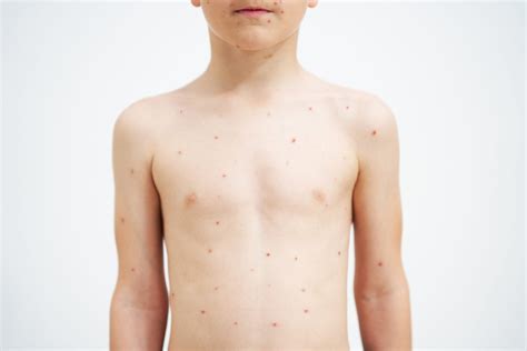 Is Shingles Contagious?: Understanding Herpes Zoster | STC