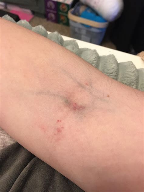 Flebitis Op De Iv Plaats Tromboflebitis (oppervlakkige Veneuze