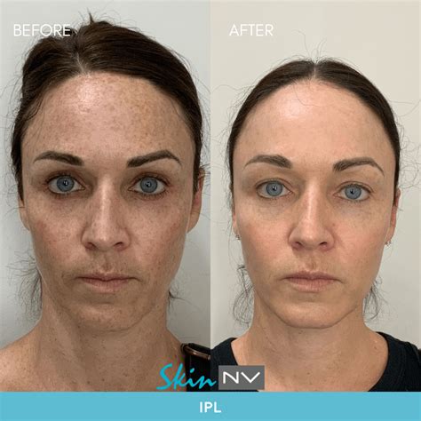 Ipl Laser For Under Eye Circles at Terri Kent blog