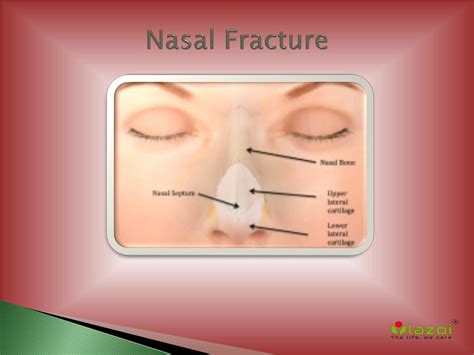 PPT - Nasal Fracture : Broken Nose Symptoms, Signs, Surgery & Treatment ...