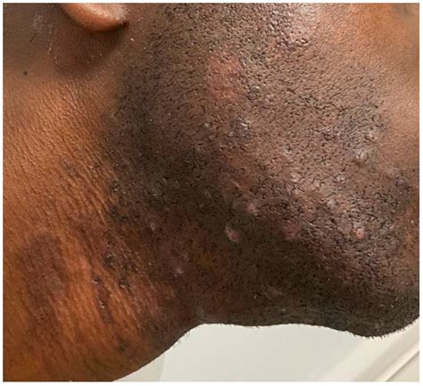 Hyper- and Hypopigmentation in a Subject with Fitzpatrick Skin Phototype VI: A New Treatment Option