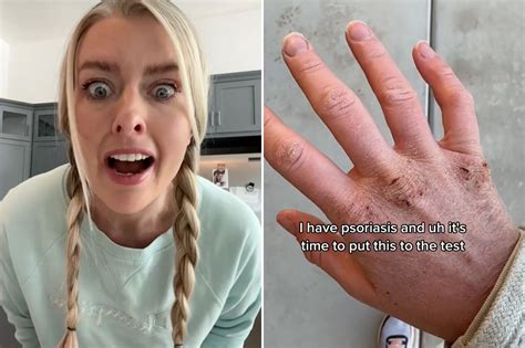 Mom treats skin condition with breast milk