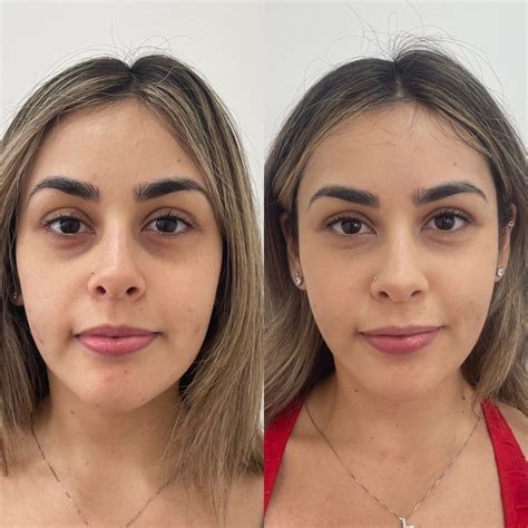 How To Fix Tired Eyes with Under Eye Fillers - Beauty Boost Med Spa