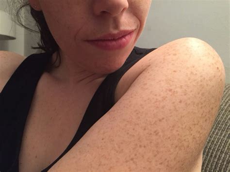 Those Bumps On Your Upper Arms Are Called Keratosis Pilaris, And They're More Common Than You Think