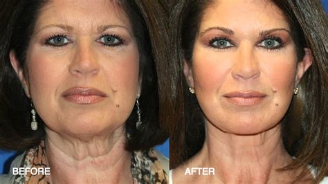 What Is Face Grafting at Aurea Allison blog