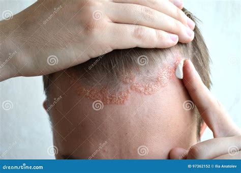 Anoint With Cream, Ointment, Medicine Forehead, Hair Line, Scalp With Psoriasis, Dermatitis ...