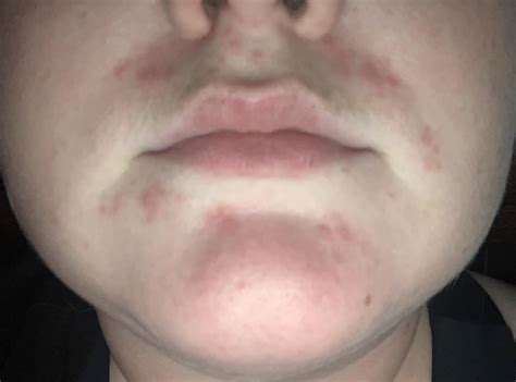 rash around mouth won’t go away any advice? : r/DermatologyQuestions