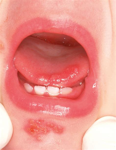 Herpes Simplex Virus - Clinical Tree