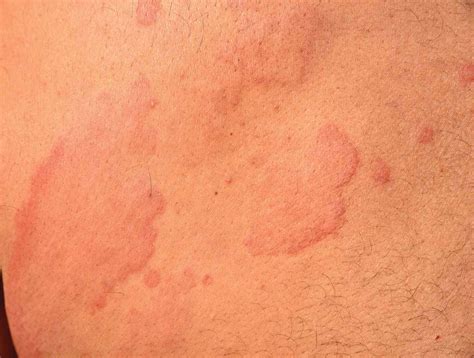 Hives vs. Eczema: Symptoms, Causes, Treatment