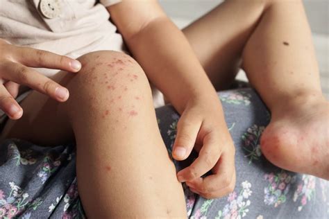 Hand Foot and Mouth Disease in South Africa: What You Need to Know