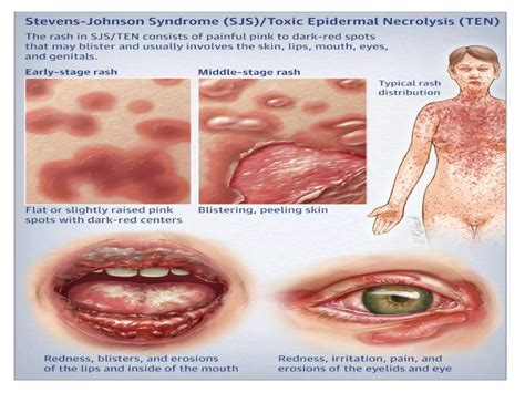 Johnson Syndrome Images