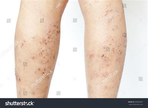 Eczema Bumps On Legs