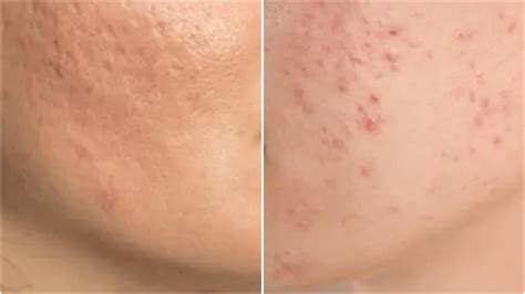 Acne Marks vs Acne Scars: Spot the Key Differences - Copenhagen Fashion Summit
