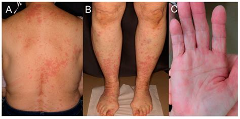A Case of Mycoplasma Infection with an Atypical Presentation of ...