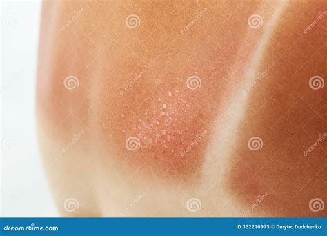 A Woman with Reddened, Itchy Skin after Sunburn on White Background. Stock Image - Image of ...