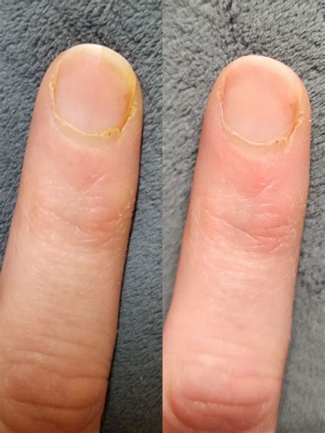 yellow discoloration of 2 fingernails/nail folds developed over 5-7 days, now starting to clear ...