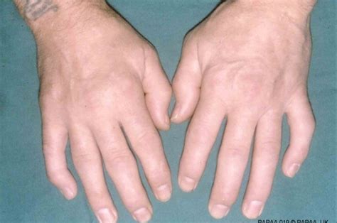 What questions should I ask about psoriatic arthritis?