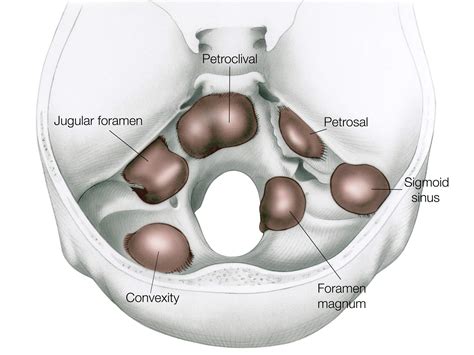 Surgery for Acoustic Neuroma: Translabyrinthine Approach | The Neurosurgical Atlas