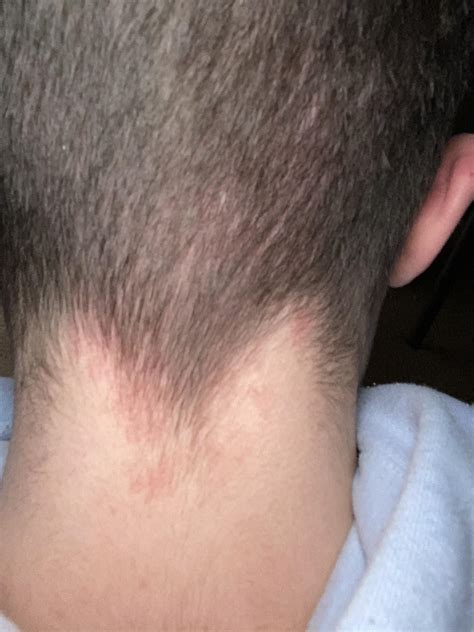 Itchy rash on back of neck : r/medical_advice