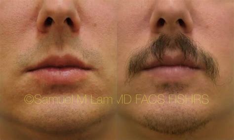 Lips Reduction Surgery Before And After | Lipstutorial.org