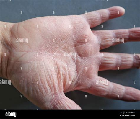 Eczema dermatitis on hands hi-res stock photography and images - Alamy