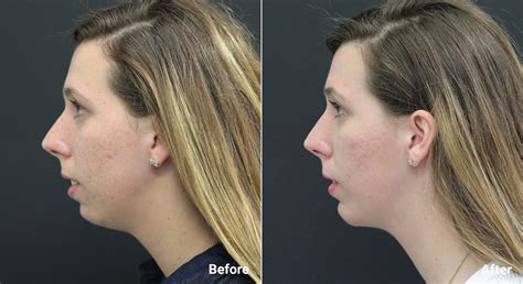 Chin Implants: Procedure, Recovery, Pictures, & Risks