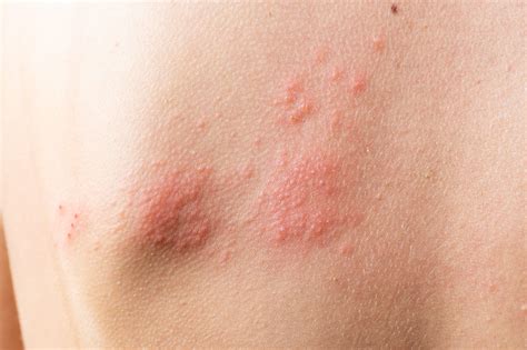 ¿Qué es la dermatitis atópica? | DermaPeople
