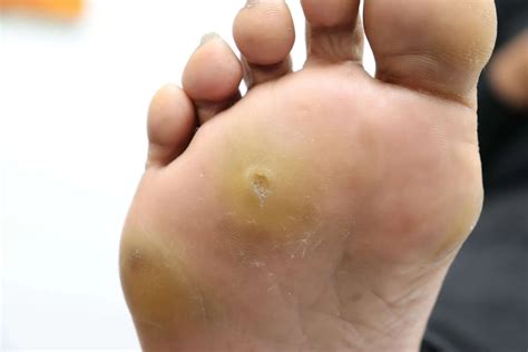 Understanding Corns on Feet: Causes, Treatments, and Prevention - Achieve Podiatry | Port Macquarie